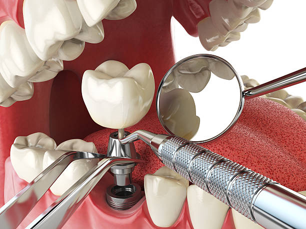 Best Emergency Wisdom Teeth Removal in Blue Ridge, VA